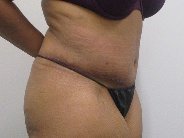 Abdominoplasty Before & After