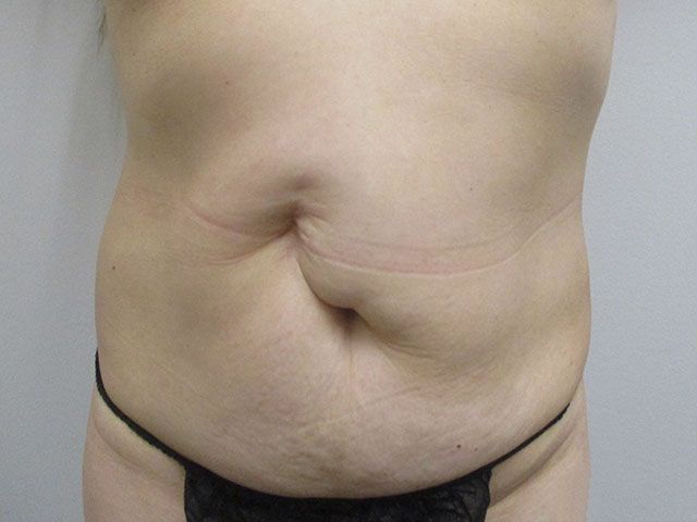Abdominoplasty Before & After