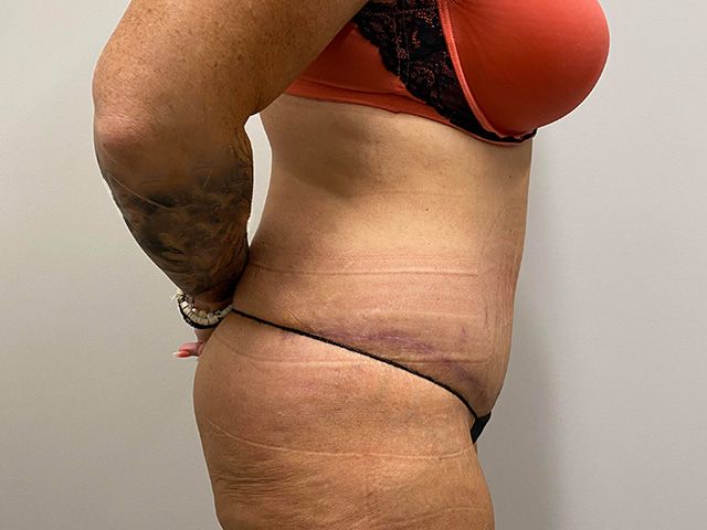Abdominoplasty Before & After