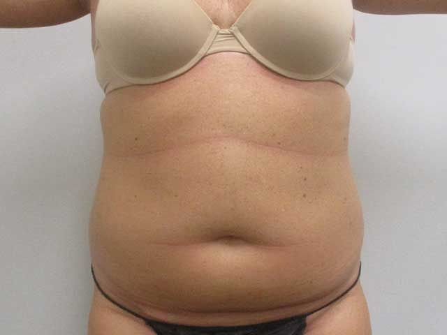 Abdominoplasty Before & After