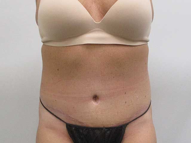 Abdominoplasty Before & After