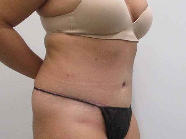 Abdominoplasty Before & After