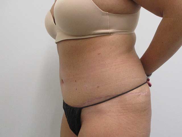 Abdominoplasty Before & After