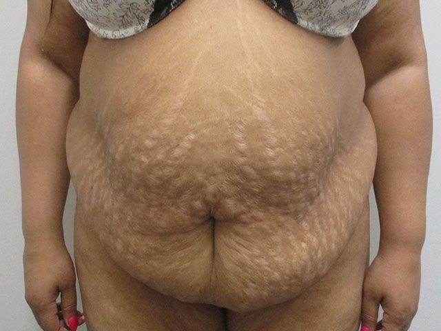 Abdominoplasty Before & After