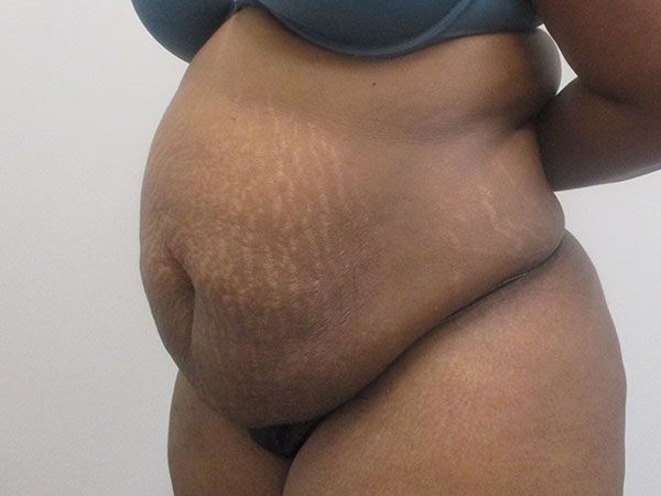 Abdominoplasty Before & After