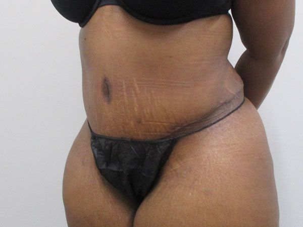Abdominoplasty Before & After