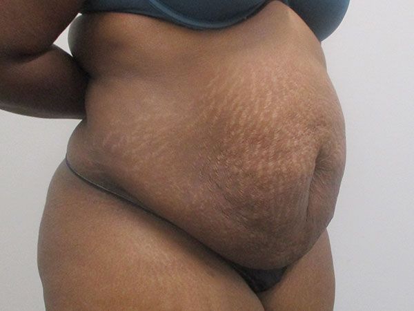 Abdominoplasty Before & After