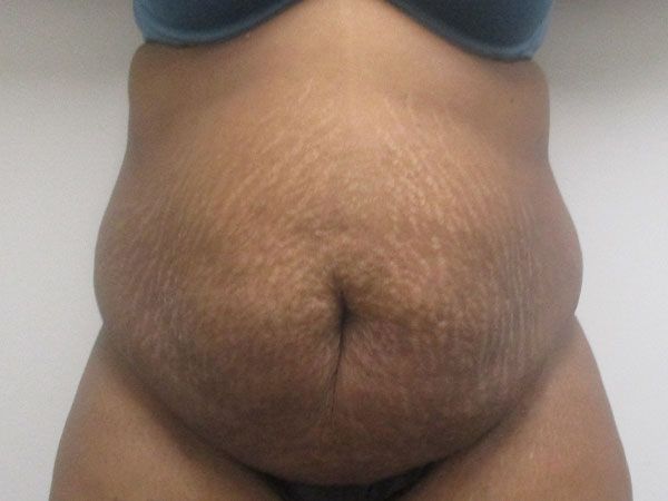 Abdominoplasty Before & After