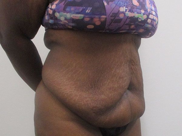 Abdominoplasty Before & After