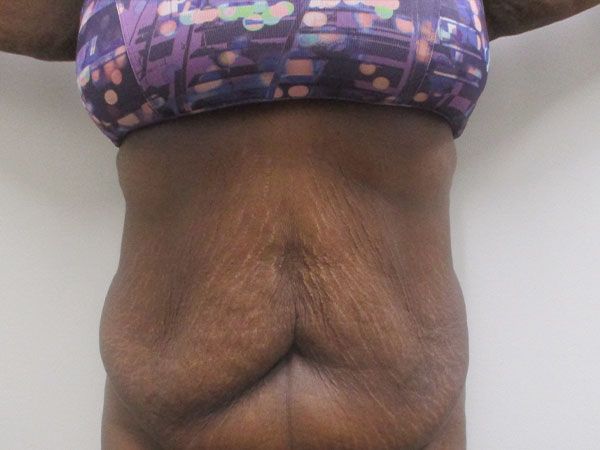 Abdominoplasty Before & After