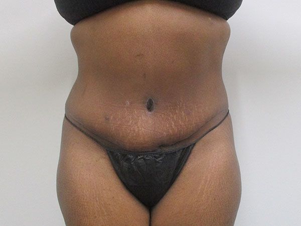 Abdominoplasty Before & After