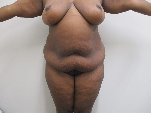 Abdominoplasty Before & After