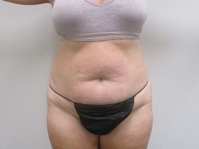 Abdominoplasty Before & After