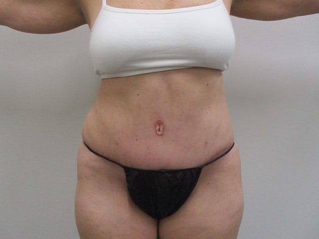 Abdominoplasty Before & After