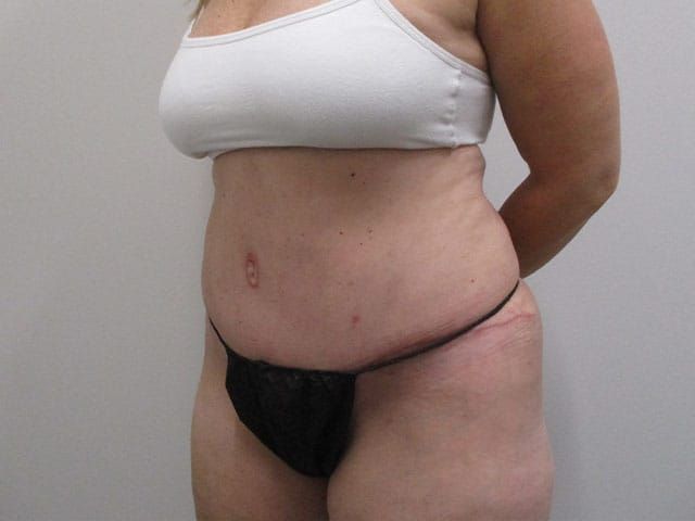 Abdominoplasty Before & After