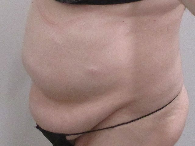 Abdominoplasty Before & After