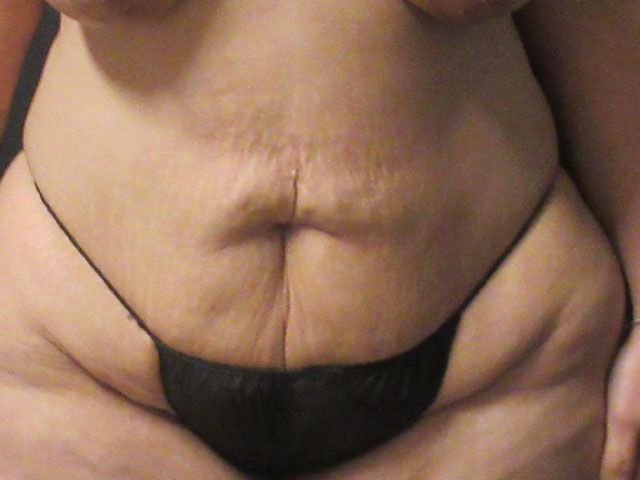 Abdominoplasty Before & After
