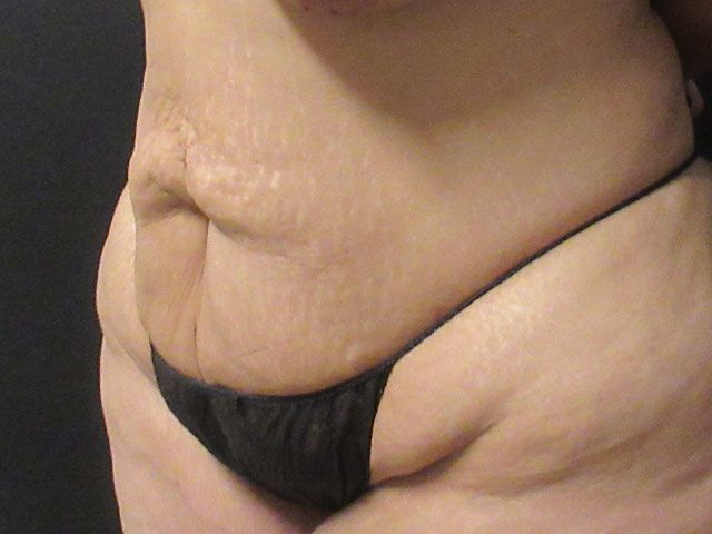 Abdominoplasty Before & After