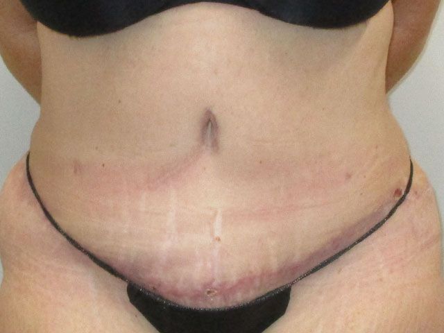 Abdominoplasty Before & After