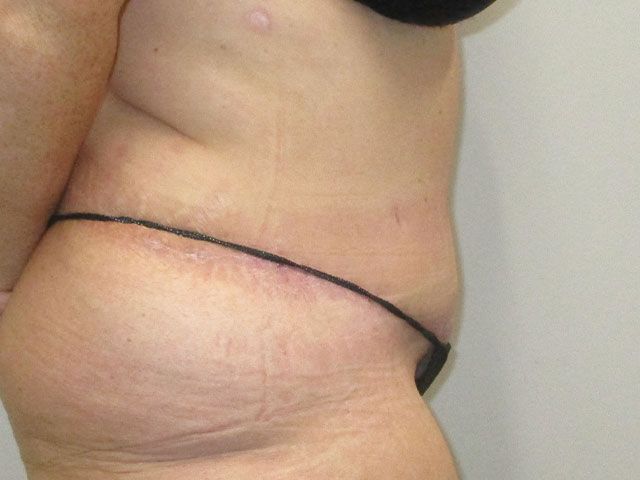 Abdominoplasty Before & After