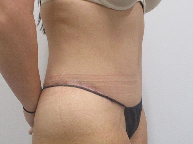 Abdominoplasty Before & After