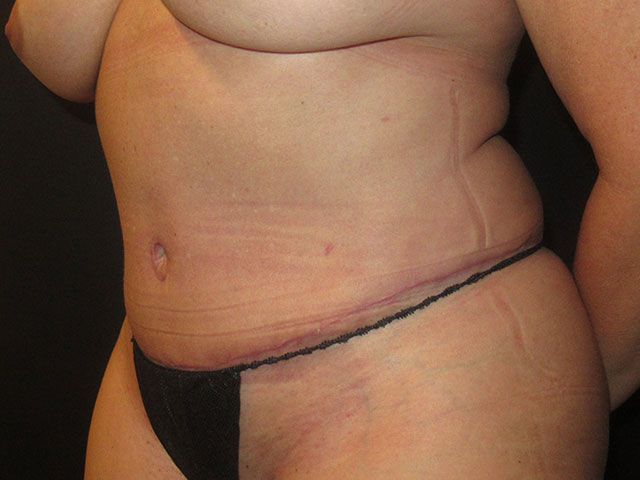 Abdominoplasty Before & After