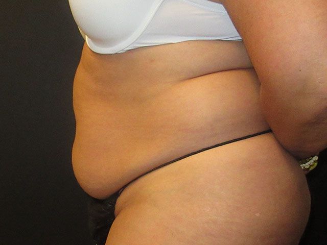 Abdominoplasty Before & After