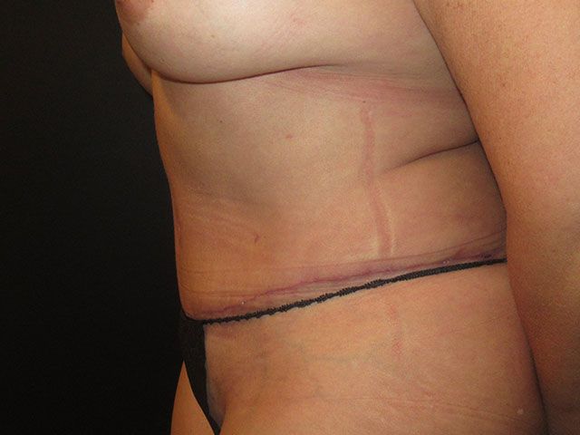 Abdominoplasty Before & After