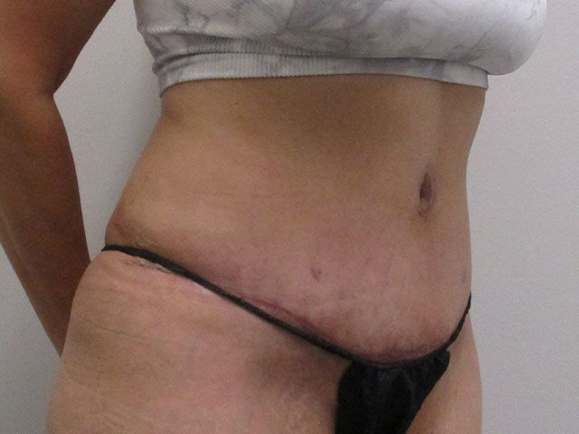 Abdominoplasty Before & After