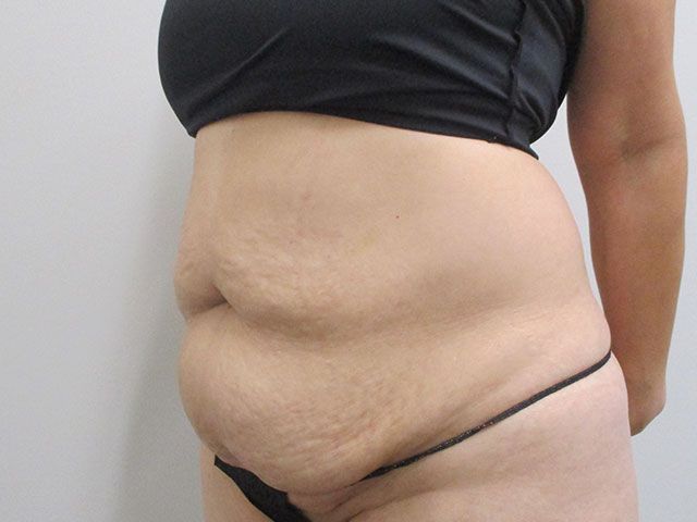Abdominoplasty Before & After