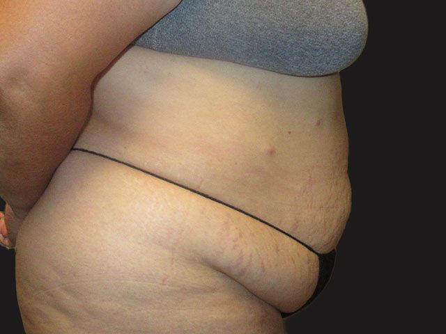Abdominoplasty Before & After