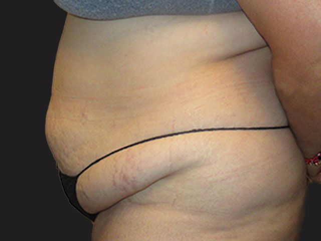 Abdominoplasty Before & After