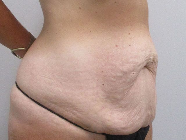 Abdominoplasty Before & After
