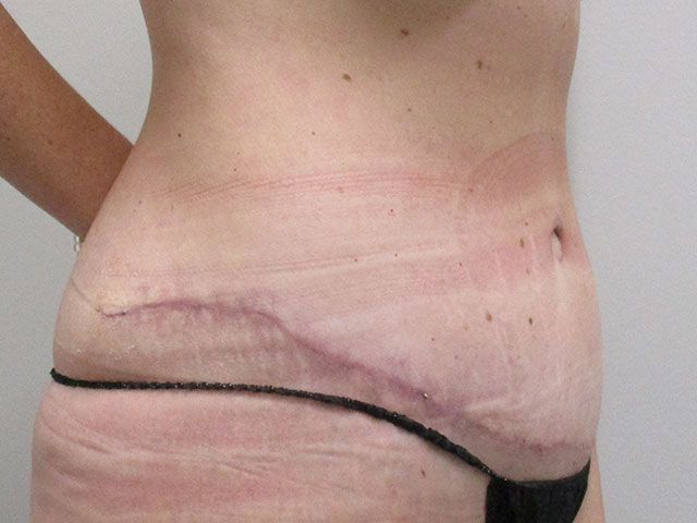 Abdominoplasty Before & After