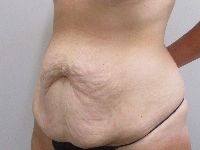 Abdominoplasty Before & After