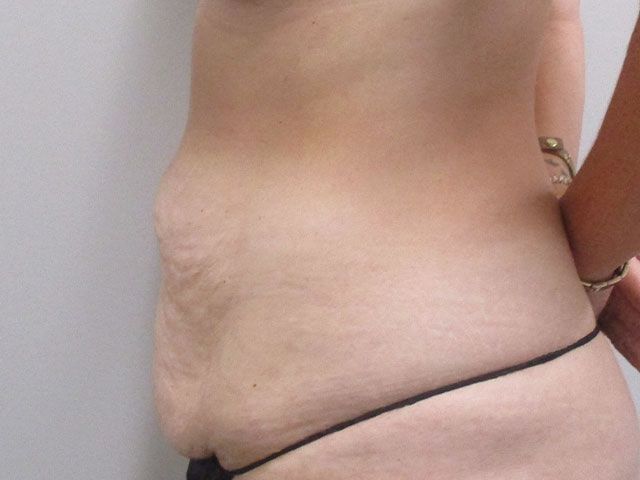 Abdominoplasty Before & After