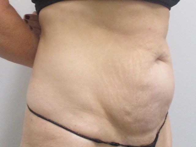Abdominoplasty Before & After