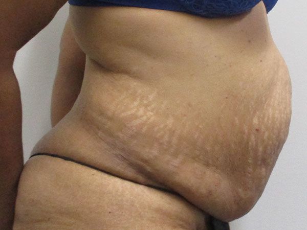 Abdominoplasty Before & After