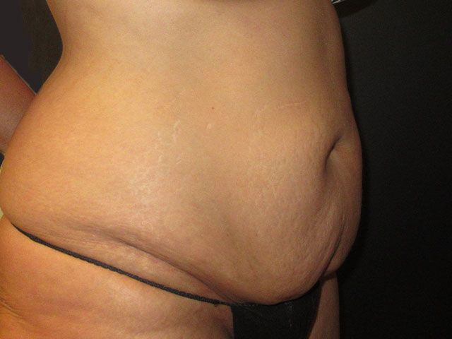 Abdominoplasty Before & After