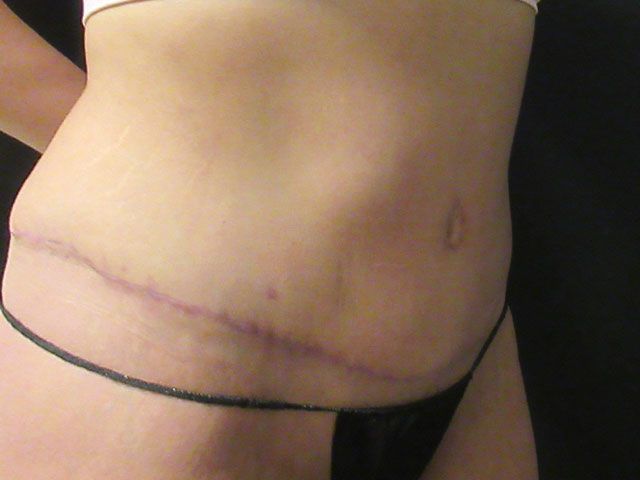 Abdominoplasty Before & After