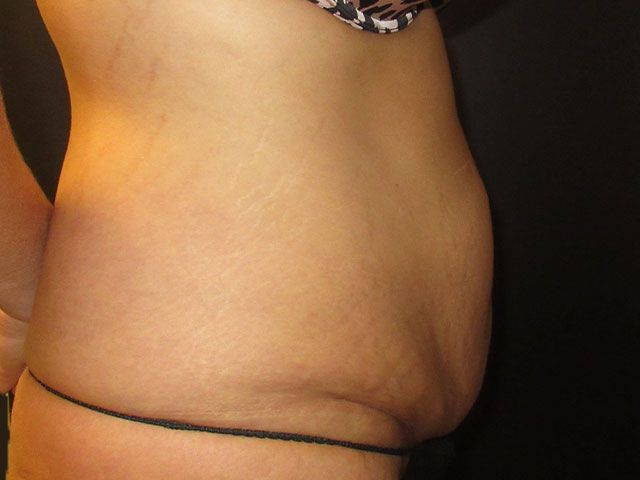 Abdominoplasty Before & After