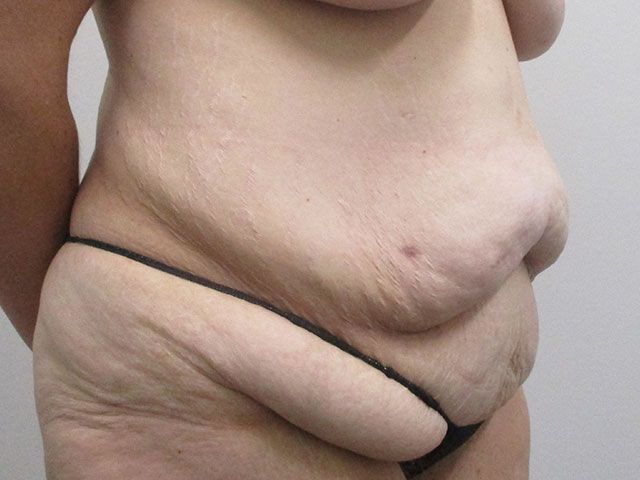 Abdominoplasty Before & After
