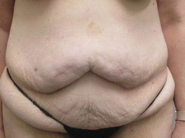 Abdominoplasty Before & After