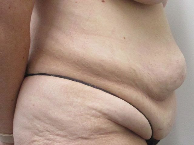 Abdominoplasty Before & After