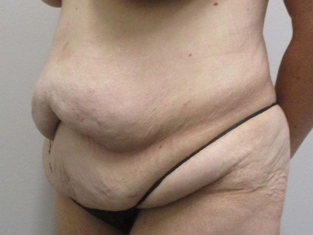 Abdominoplasty Before & After