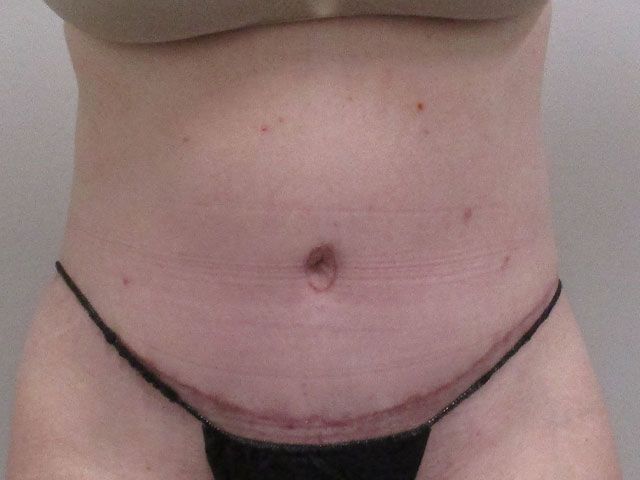 Abdominoplasty Before & After