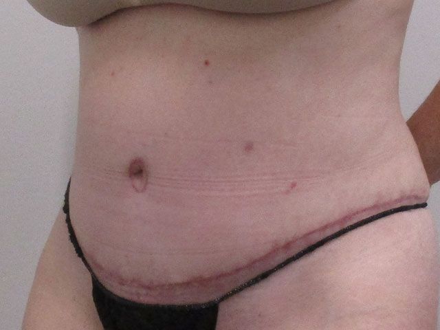 Abdominoplasty Before & After
