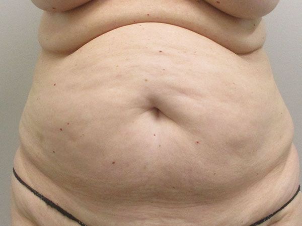 Abdominoplasty Before & After