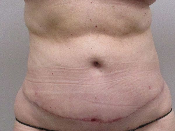 Abdominoplasty Before & After