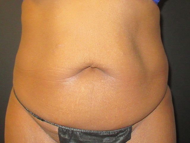 Abdominoplasty Before & After